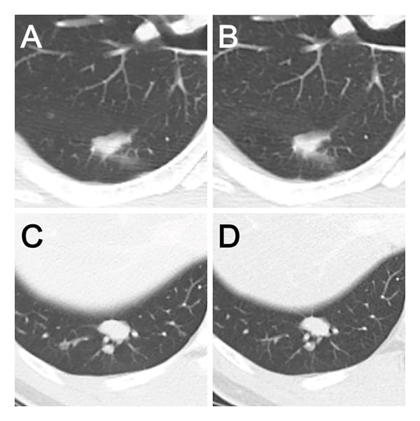 Chest CT pairs showing pulmonary nodules during staging and treatment of myxoid liposarcoma.