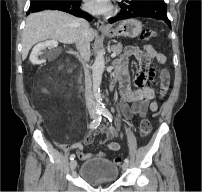 Coronal contrast-enhanced CT showing a large right retroperitoneal liposarcoma.