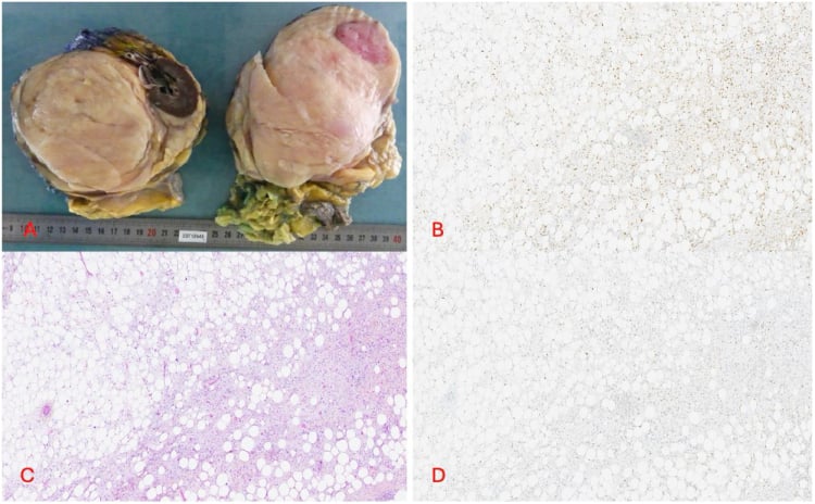 Macroscopic retroperitoneal liposarcoma resection specimen with H&E sections.