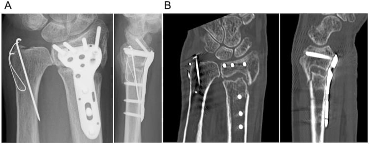 Radiographs and CT of a distal radius fracture showing delayed union three months after plate fixation, before LIPUS treatment