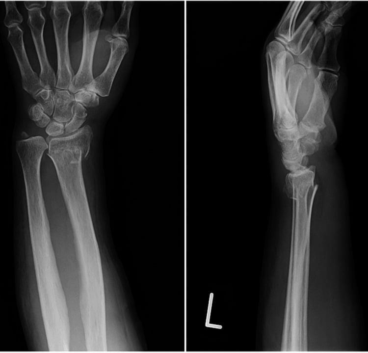 Preoperative PA and lateral radiographs of distal radius fracture