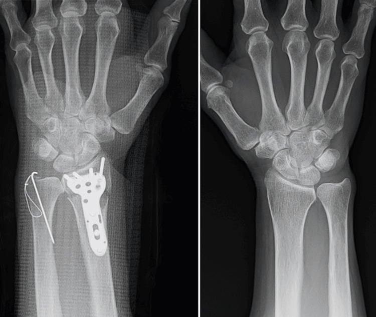 Immediate postoperative PA radiograph following volar locking plate fixation