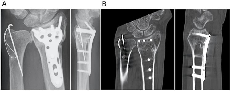 Radiographs and CT of the same distal radius fracture showing complete union five months after starting LIPUS treatment