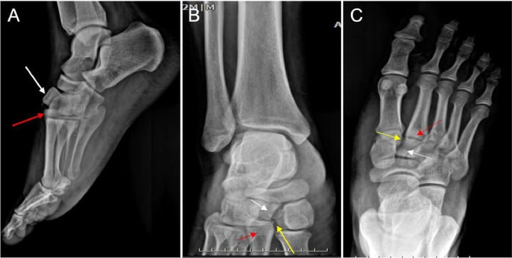 Lisfranc injury radiographs showing pathognomonic fleck sign on lateral, oblique, and AP views