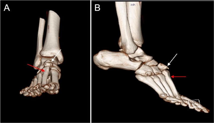 3D CT reconstruction showing Lisfranc injury with dorsal dislocation of intermediate cuneiform and 2nd metatarsal