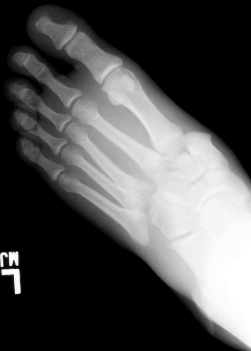 Classic Lisfranc diastasis on weight-bearing AP foot X-ray