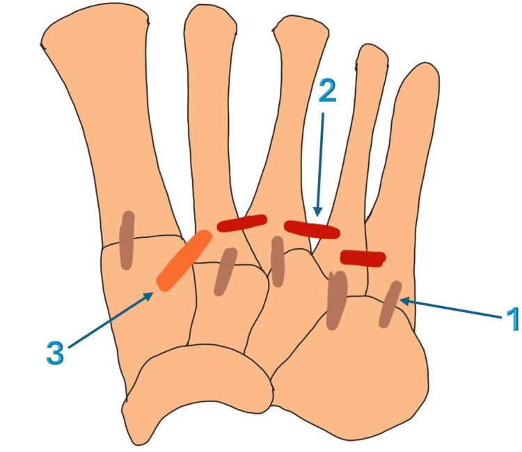 Midfoot ligamentous network showing tarsometatarsal ligaments, intermetatarsal ligaments, and Lisfranc ligament complex