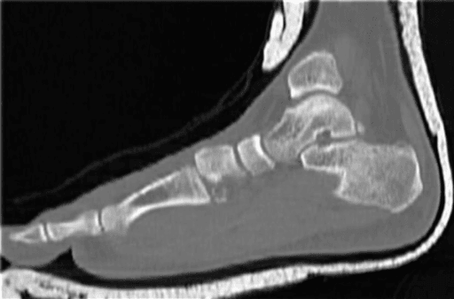 Sagittal CT reconstruction of Lisfranc injury