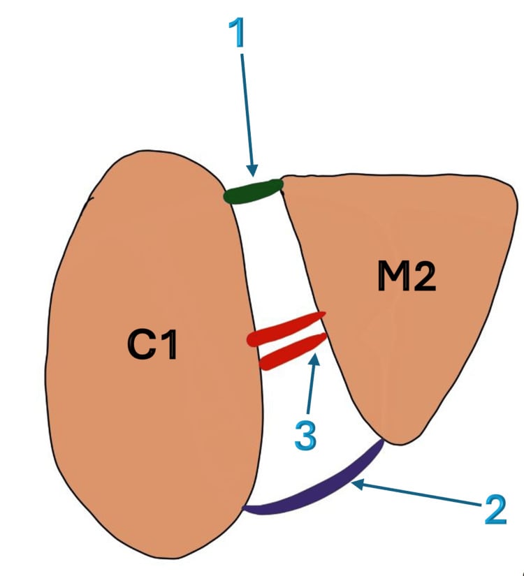 Detailed anatomy of Lisfranc ligament showing medial cuneiform (C1), second metatarsal (M2), and three ligament bundles