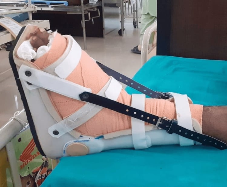 Ankle foot orthosis (AFO) used in rehabilitation after Lisfranc fracture fixation