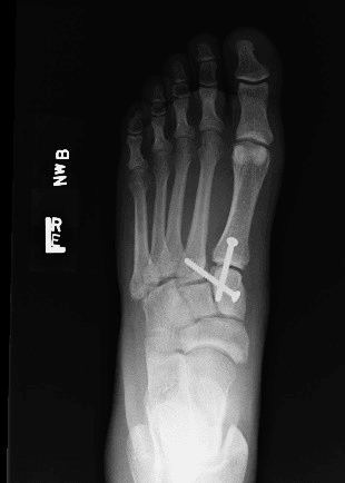 Post-operative Lisfranc screw fixation radiograph