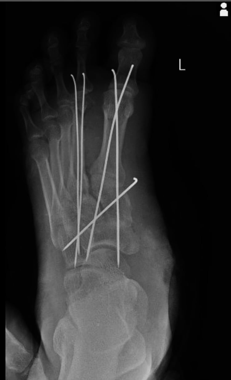 Post-operative radiograph showing K-wire fixation of first and second metatarsals after Lisfranc injury reduction