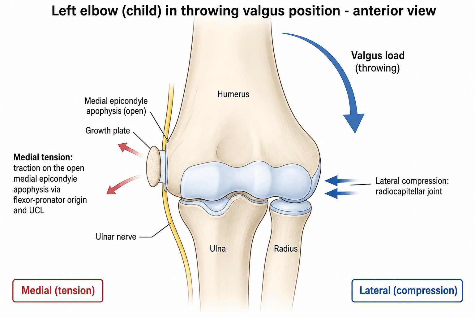 Labelled schematic of a child's left elbow in a throwing valgus position showing medial tension on the open medial epicondyle apophysis and lateral radiocapitellar compression