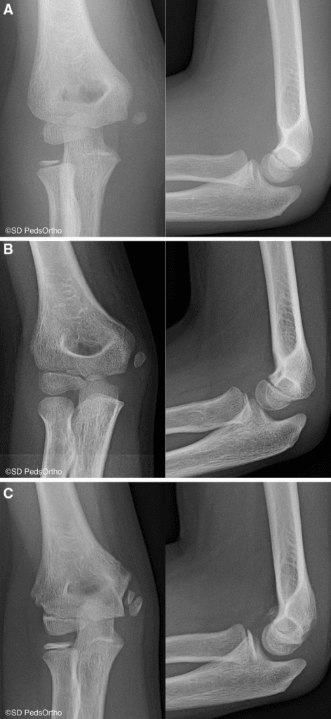 Three-row sequence of paediatric elbow anteroposterior and lateral radiographs showing a medial epicondyle fracture fragment and later healing or nonunion changes