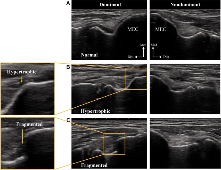 Long-axis ultrasound classification of medial humeral epicondyle morphology: normal, fragmented and hypertrophic patterns