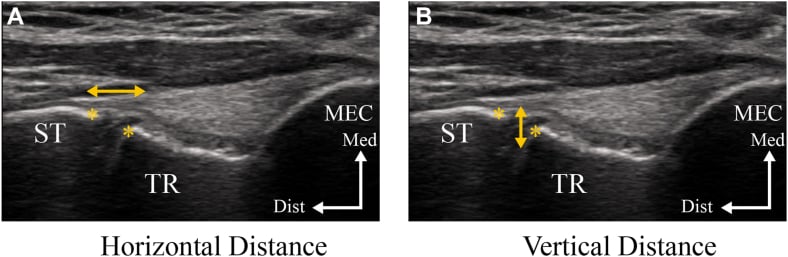 Ultrasound measurement of horizontal and vertical medial elbow joint-space distance