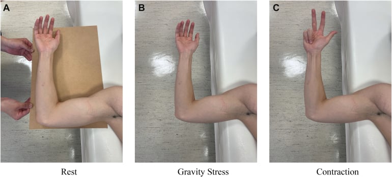 Ultrasound assessment of medial elbow joint space at rest, gravity stress and flexor-pronator contraction