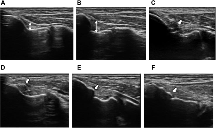 Ultrasound examples of medial elbow thickening, hypoechoic lesion, bone fragments, hypertrophy and cortical irregularity