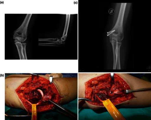 Four-panel figure with elbow radiographs and intraoperative medial elbow photographs showing medial epicondyle fracture treatment