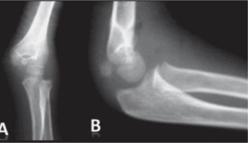 Complication: paediatric elbow dislocation with a medial-sided epicondylar fragment trapped near the joint