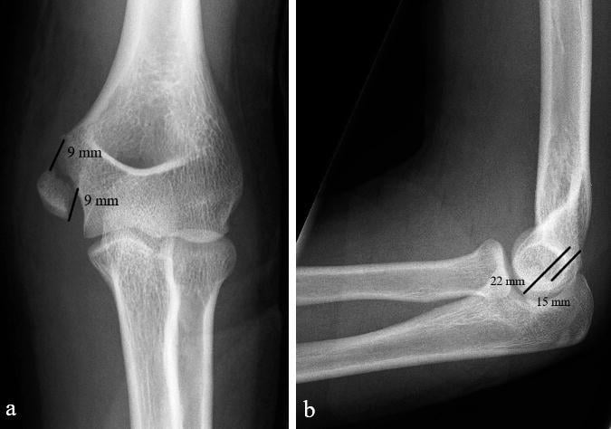 AP and lateral elbow radiographs illustrating medial epicondyle displacement measurement.