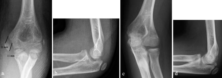 Radiographs showing nonoperative treatment and healing of a displaced medial epicondyle fracture.