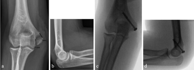 Radiographs showing screw fixation and follow-up of a displaced medial epicondyle fracture.