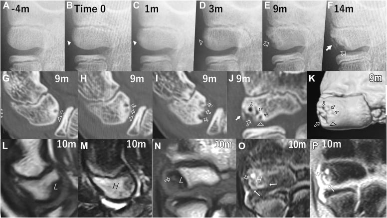 Serial elbow radiographs showing progression of capitellar osteochondritis dissecans.