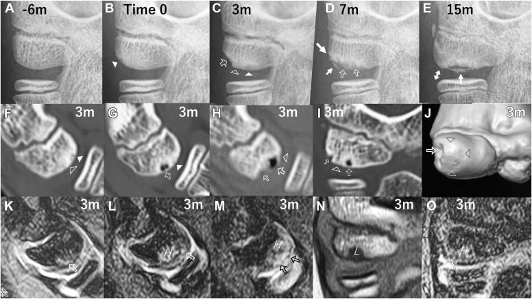 Serial elbow radiographs and MRI showing evolution of capitellar osteochondritis dissecans.