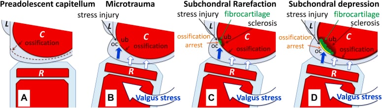 Schematic showing repetitive compression and shear leading to capitellar osteochondritis dissecans.