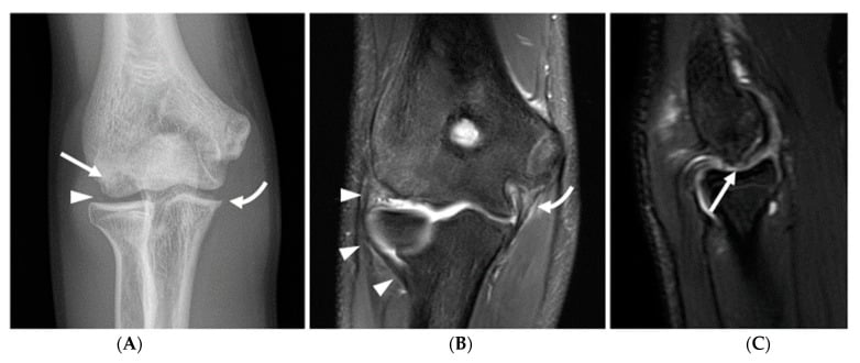 AP radiograph showing capitellar lucency with an intra-articular body and an ulnar traction spur in a teenage pitcher