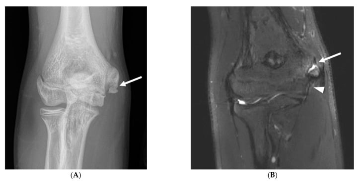 AP radiograph and coronal fat-saturated T2 MRI of an acute medial epicondylar apophyseal avulsion in a young pitcher