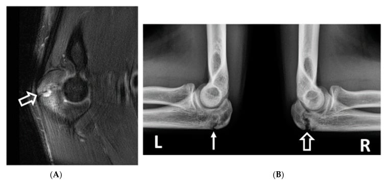 Sagittal fat-saturated T2 MRI showing olecranon physeal irregularity with oedema and bilateral comparison radiographs