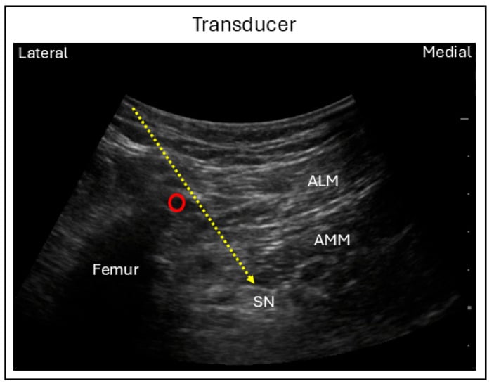 Ultrasound of sciatic nerve block using the anterior technique with the femoral artery marked