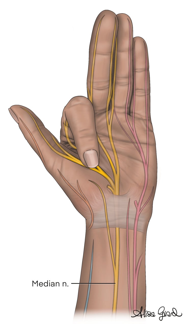 Illustration showing localisation of the median nerve for a digital block at the thenar eminence