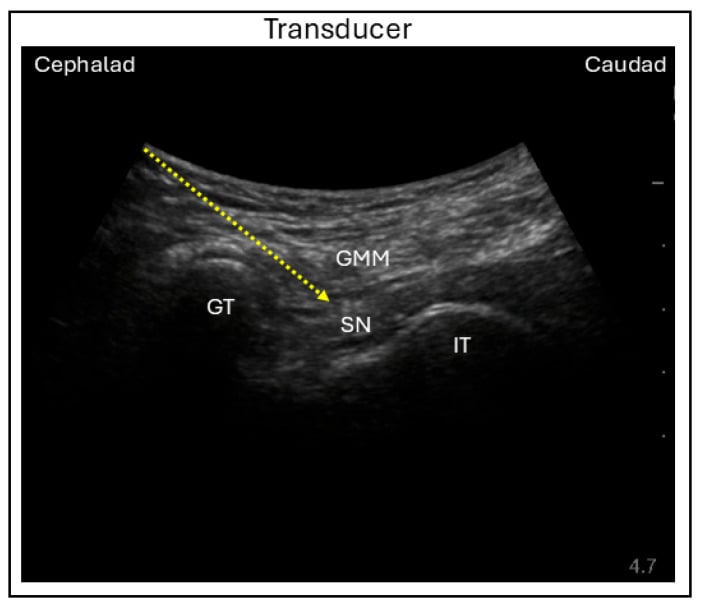 Ultrasound of in-plane lateral subgluteal sciatic nerve block with greater trochanter and ischial tuberosity marked