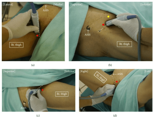 Patient and transducer positions for ultrasound-guided obturator nerve block techniques