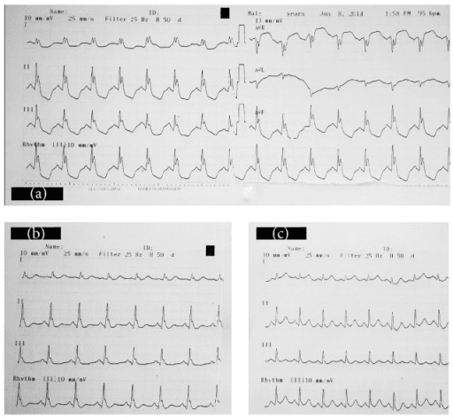 Electrocardiogram before and after intravenous lipid emulsion treatment in local anaesthetic systemic toxicity