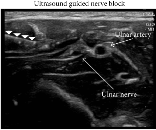 Ultrasound image labelled 'Ultrasound guided nerve block' with arrowheads marking a needle and arrows labelling the ulnar artery and ulnar nerve
