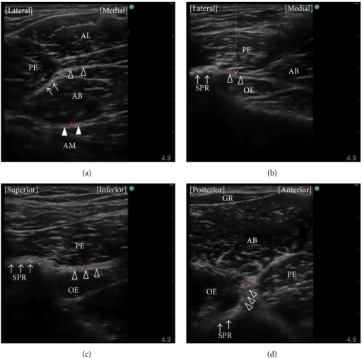 Four-panel ultrasound of the medial thigh showing adductor muscle layers labelled AL, AB, AM with arrows and dashed lines along the fascial planes
