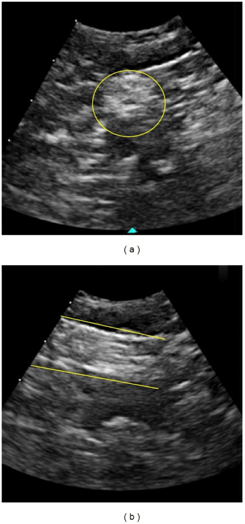 Two-panel ultrasound of the sciatic nerve at the popliteal fossa, panel (a) showing a circled round structure and panel (b) showing an elongated structure between two lines