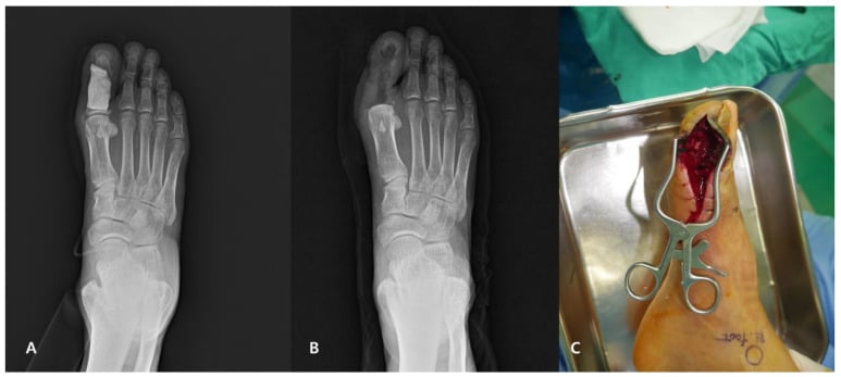 Forefoot antibiotic cement spacer case in osteomyelitis