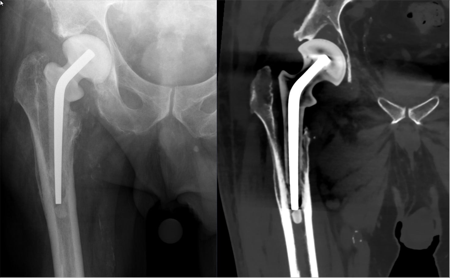 AP radiograph and CT of an antibiotic cement hip spacer
