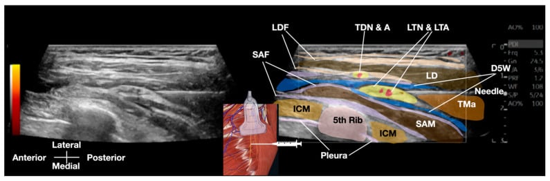 Ultrasound Identification of the Long Thoracic Nerve