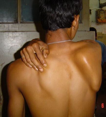 Clinical photograph (posterior view) of medial scapular winging in long thoracic nerve palsy, with the medial border and inferior angle of the scapula lifting off the chest wall.