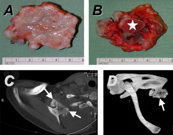 Structural Pseudo-Winging from Scapular Osteochondroma