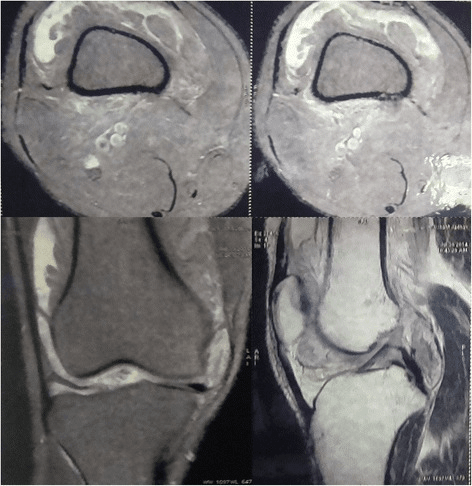 Knee MRI composite showing frond-like synovial proliferation around the distal femur