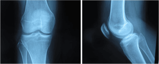 Anteroposterior and lateral X-rays of a right knee appearing normal.