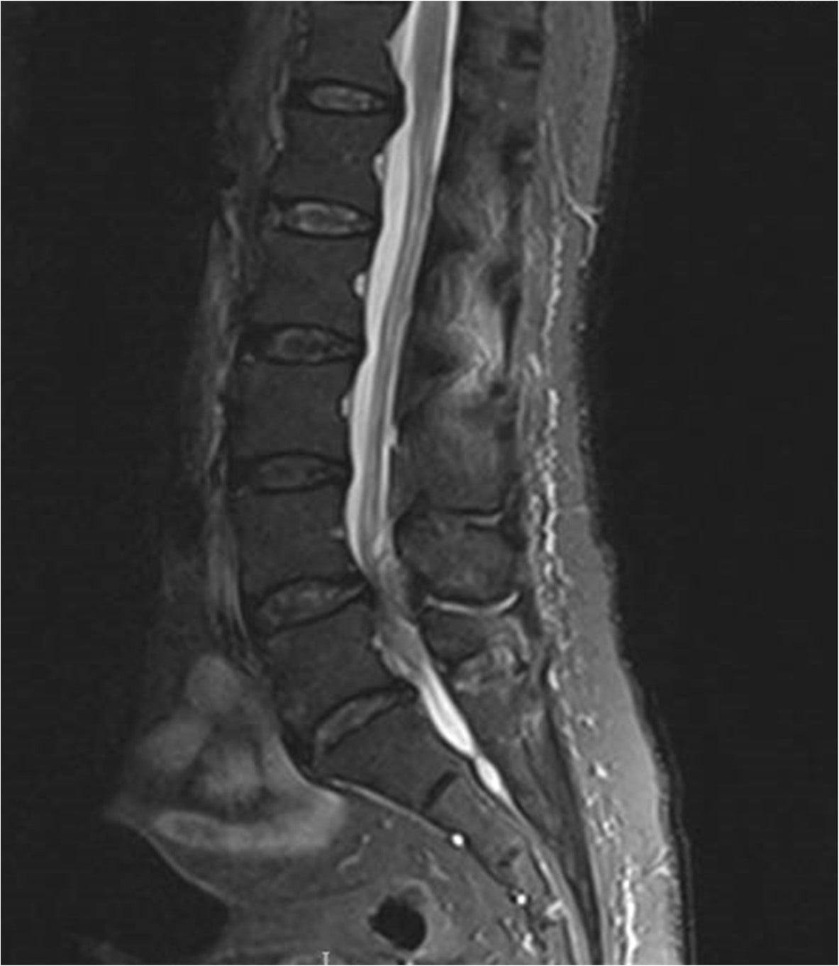 Sagittal lumbar spine MRI showing a posterior epidural abscess compressing the thecal sac and causing cauda equina syndrome
