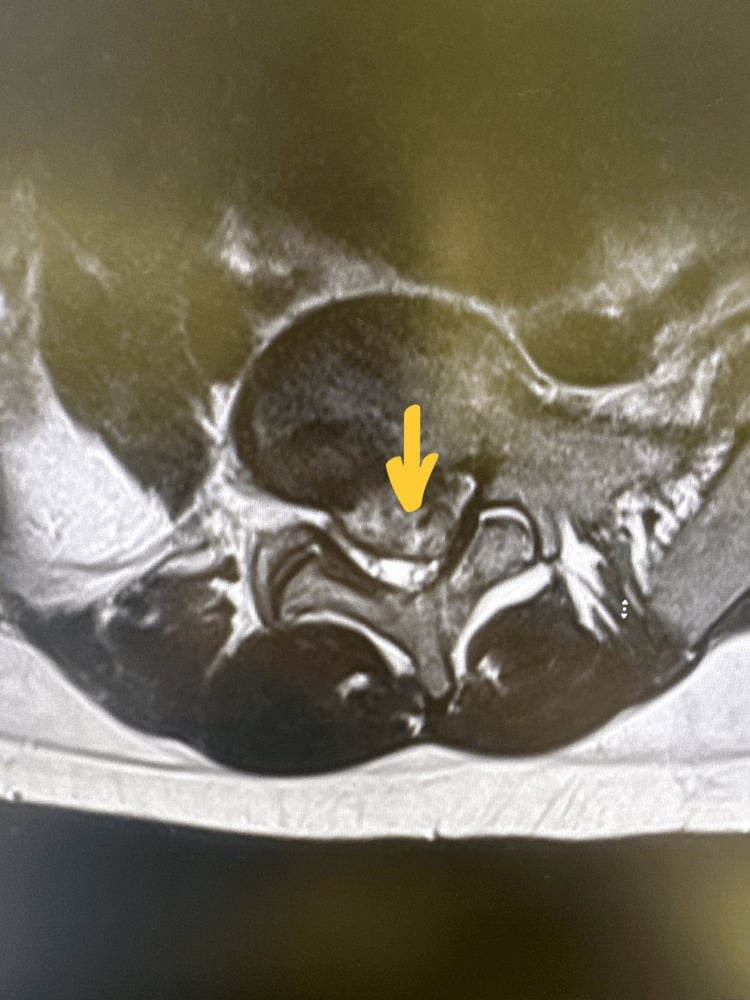 Axial T2 lumbar MRI showing a massive posterior disc extrusion obliterating the canal and both lateral recesses